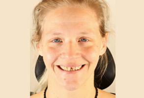 Healdsburg Oral Surgery   Dental Implants | Implant Dentistry, General Anesthesia and Wisdom Teeth Extractions